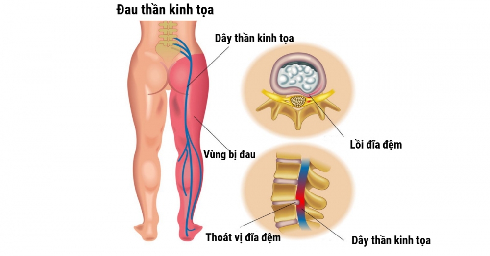 Các tư thế yoga giúp cải thiện chứng đau dây thần kinh tọa